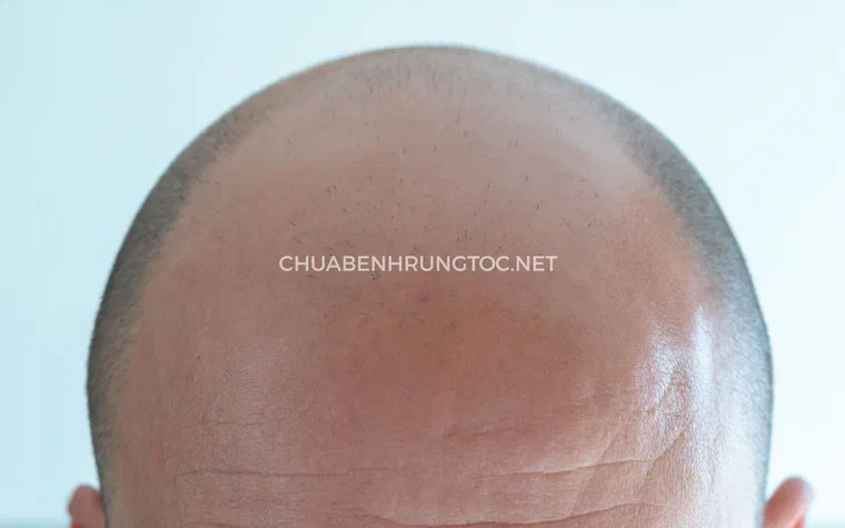 Vùng đỉnh đầu của nam giới bị hói, tóc thưa dần và để lộ da đầu