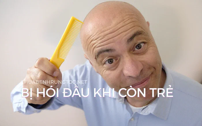7 nguyên nhân bị hói đầu còn trẻ và cách chăm sóc hiệu quả