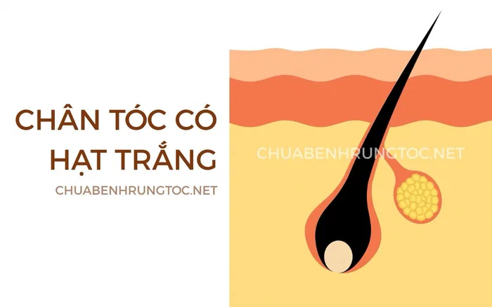 Chân tóc có hạt trắng: 3 nguyên do bạn cần biết