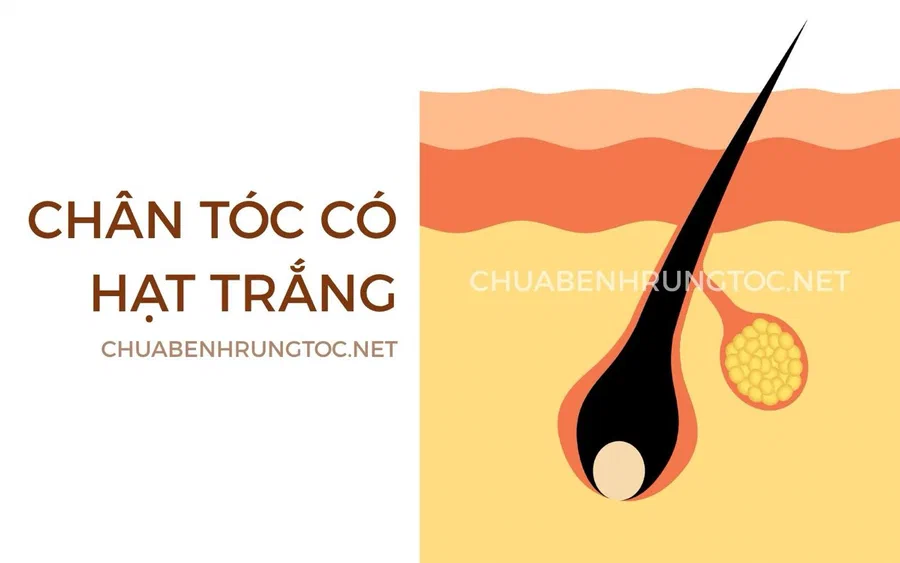 Chân tóc có hạt trắng: 3 nguyên do bạn cần biết
