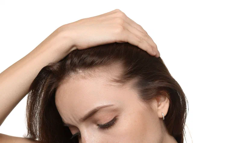 Phụ nữ vén tóc để lộ đường ngôi rộng ra và tóc thưa dần ở vùng trán