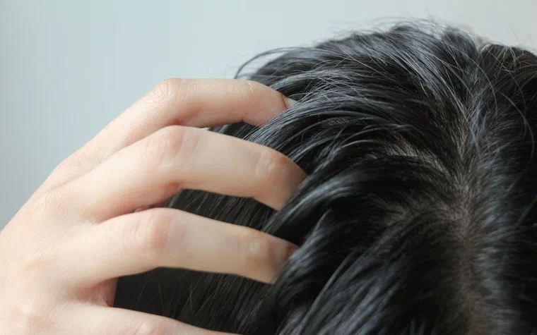 Bàn tay luồn vào tóc gãi vùng đỉnh đầu vì ngứa da đầu