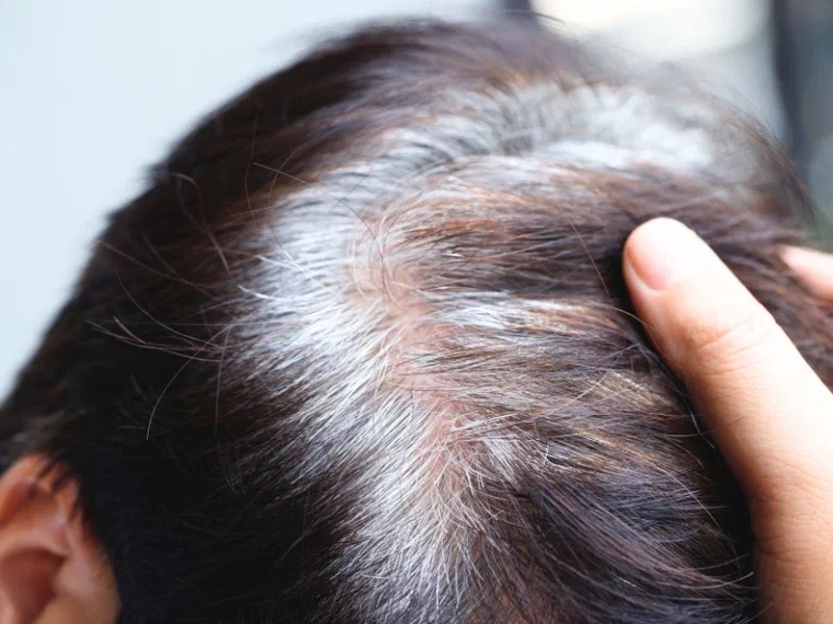 Tóc bạc sớm xuất hiện lẻ tẻ ở vùng đỉnh và thái dương